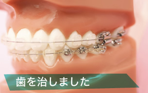 歯を治しました